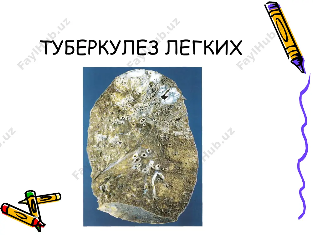 узлов. варианты течения первичного туберкулеза 1. затухание первичного туберкулеза и заживление очагов первичного комплекса: 2. прогрессирование первичного туберкулеза с генерализацией процесса: 3. хроническое течение (хронически текущий первичный туберкулез). варианты течения первичного туберкулеза затухание первичного туберкулеза и зажив­ ление очагов первичного комплекса. первичный легочный аффект инкапсулируется, обызвествляется, подвергается осснфикации; заживший аффект называют очагом гона. на месте туберкулезного лимфангита вследствие фиброзирования туберкулезных бугорков возникает фиброзный тяж. пораженные лимфатические узлы петрифицируются и оссифицируются. на месте туберкулезной язвы в кишке образуется рубчик. варианты течения первичного туберкулеза прогрессирование первичного туберкулеза с генерализацией процесса проявляется в четырех формах: гематогенной, лимфогенной, роста первичного аффекта и смешанной. варианты течения первичного туберкулеза а. гематогенная форма прогрессирования связана с попаданием микобактерий в кровь, проявляется в двух формах: ° милиарной, для которой характерно появление в органах множественных просовидных туберкулезных бугорков; ° крупноочаговой, при которой образуются более крупные очаги. варианты течения первичного туберкулеза лимфогенная форма прогрессирования проявляется вовлечением в туберкулезный процесс новых …
