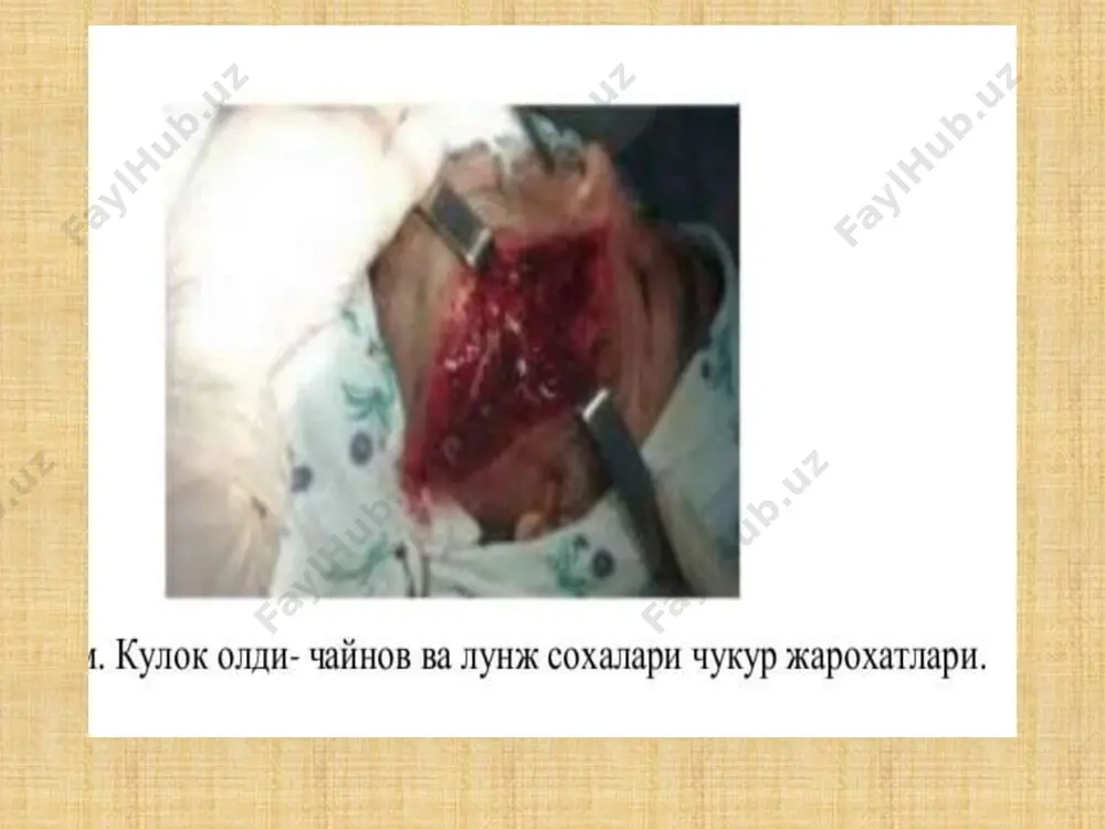 lishda ta'sir etuvchi kuch zarbidan ildiz tish katakchasi tubining kortikal plastinkasini yorib, jatning tovaksimon ktssmiga “kokilgandek” kirib ketadi. krn-tomir-nerv tutami va periodont tukimalari butunlay uziladi. tish, jat suyagining alveolyar usik kismida yorib, ichkariga kirganligi uchuy sikilib koladi. klinik manzarasi: bemor, jaroxatlangan tishini kursata oladi, 33 otrikdan shikoyat kiladi. karal ganda, kokilib kolgan tish pastki jagda - katordagilardan pastrok, yukori jatda - yukorirok joylashgan buladi. kokilgan tish uz uki atrofida aylanib, xar xil darajada “burilgan” buladi. tish suyakka kancha chukur kirsa, shuncha kalta bulib, kurinadi. ayrim xollarda alveolyar usikda tishning kesuv kirrasi kurinadi, tish suyakda sikilib kolganligi bone kimirlamaydi. tish pulpasi nekrozga uchraydi 16-rasm. sillik; shina yordamida tishlar fiksatsiyasi. tish (fracturae dentis) sinishi. tishlarning tulik bulmagan va tulik sinishlari farklanadi. tishlarga mexanik kuch ma'lum yunalishda 35 zarb bilan ta'sir etgan (yikilishi, urilish, zarb okibatida) yuzaga keladi. tish sinishida, uning pulpa (pulpae dentis) si zararlanishi yoki beziyon kolishi mumkin. tishning fakat emaligina …
