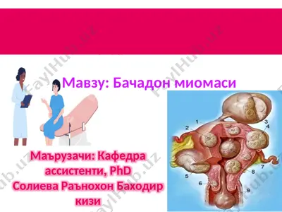 bachadon miomasi — PPTX