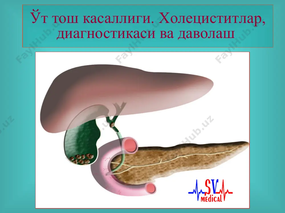 qichlari 1. fizik va ximik jarayon (litogen o't suyuqligi) bosqichi - klinik manzara yo'q. 2. latent (belgisiz) kechim - o't pufagidagi tosh bezovta qilmaydi, ular boshqa sabablarga ko'ra tekshiruvlarda topiladi. 3. yaqqol namoyon bo'lgan klinik manzara. o'tkir xoletsistit, xoledoxolitiaz, fater so'rg'ichi stenozi, mexanik sariqlik, o'tkir xolangit, o'tkir pankreatit va boshqalar rivojlanishi. o'tkning sub'ektiv belgilari: o'ng qovurg'a ravog'i ostidagi og'riq, ko'ngil aynishi, og'izda achchiq ta'm sezgisi, jig'ildon kaynashi, zarda bo'lish, qayt qilish (qusish), og'riqlarni ovqatlanishga bog'liqligi, qorinning dam bo'lishi, o'tkda og'riq lokalizatsiyasi o'ng qovurg'a ravog'i ostida, epigastral sohada o'tk diagnostika usullari duodenal zondlash ultratovushli tekshiruv (uzi) kontrast rentgenografiya (xoletsisto-, xolangiografiya) kompyuter tomografiya (kt) laparoskopiya magnit-rezonans tomografiya (mrt). o't pufagining normal manzarasi (uzi) 1. o't qopi bo'shlig'i 2. o't qopi devori 3. o't qopi yo'li 4. jigar to'qimasi o't pufagidagi toshlar (uzi) xoletsistografiya 1. o't qopi soyasi 2. umumiy o't yo'li soyasi 3. umurtqa pog'onasi 4. kovurg'alar xoletsistografiya (o't qopida ikkita yirik …