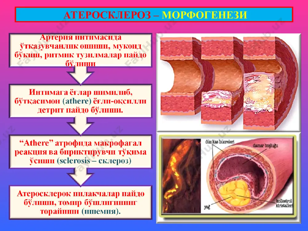 атеросклероз - Page 4
