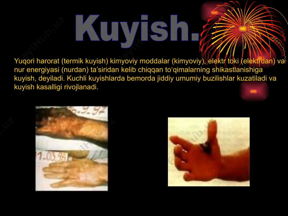 urishi), u xolda jonlantirish (tiklash) ishlariga kirishish zarur. a) birinchi navbatda barcha organlarni kislorod bilan ta’minlashning bosh manbai sifatida nafasni meyorlashtirish va inson organizmining xamma tukimalariga kislorod yetkazib beradigan kon aylanishini normalashtirish zarur. оказание помощи при ожогах iii, iv и v степени: elektr tokidan yoki boshqa baxtsiz xodisalarda jabrlanganlarga birinchi yordam. umumiy qoidalar. elektr tokidan yoki boshqa baxtsiz xodisalarda jabrlanganlarga birinchi yordam ko’rsatishda xarakatlarni tezqorligi, topkirlik va yordam ko’rsatayotgan insonning moxirligi muvaffakiyatni asosiy shartlaridir.biroq mazkur joriy qoidalarni bo’lishining zi kifoya emas. tokning inson organizmiga ta’siri va tok bo’yicha xavfsizlik mezonlari. image1.jpeg image2.jpeg image3.jpeg image4.jpeg image5.png image6.png image7.jpeg image8.jpeg image9.jpeg image10.jpeg image11.png image12.jpeg image13.png image14.png image15.png image16.png image17.png image18.png image19.png image20.png /docprops/thumbnail.jpeg