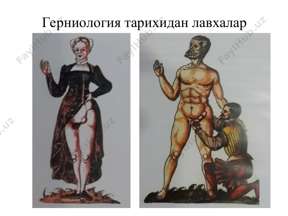 аволаш." у кўндаланг фастсияси ингуинал канали ва бошқа баъзи элементларни тасвирланган. унинг номи билан пай аталган. austin cooper (1759-1830), father of rev austin cooper (1804-1871), grandfather of austin damer cooper (1831-1900) and great grandfather of austin nathaniel cooper (1853-1898) италиялик жарроҳ э.бассини номи билан боғлиқ булган катта олдилаш юзага келган, чов чрралари жарроҳлик даволаш услуби бўича ягона контсептсиясини яратилган. 1884 йилда бассини биринчи ингуинал чурралари учун жарроҳлик услубларини баён қилган ва чов каналини орқа девори ролини замонавий тушуниш учун асос яратилди. у чов канали реконструксия тушунчаси, чов чурралари оператсия инқилоб ишлаб чиқилди. бассини ишлатиладиган пластикаси ва тамойиллари, аста-секин етакчи ўринни эгаллади. чурранинг асоратлари қисилиш тўғриланмаслик яллиғланиш копростаз чурра қисилиши – бу зудлик билан жарроҳлик амалиёти бажарилишини талаб қиладиган, энг кўп учрайдиган ва хавфли чурра асоратидир. нажасли қисилиш эластик қисилиш ретроград қисилиш ичак деворининг қисилиши (рихтер қисилиши) қисилган чурра белгилари: чурра соҳадаги оғриқ, аввал тўғриланиб турадиган чурранинг тўғриланмай қолиши, чурра бўртмасида …