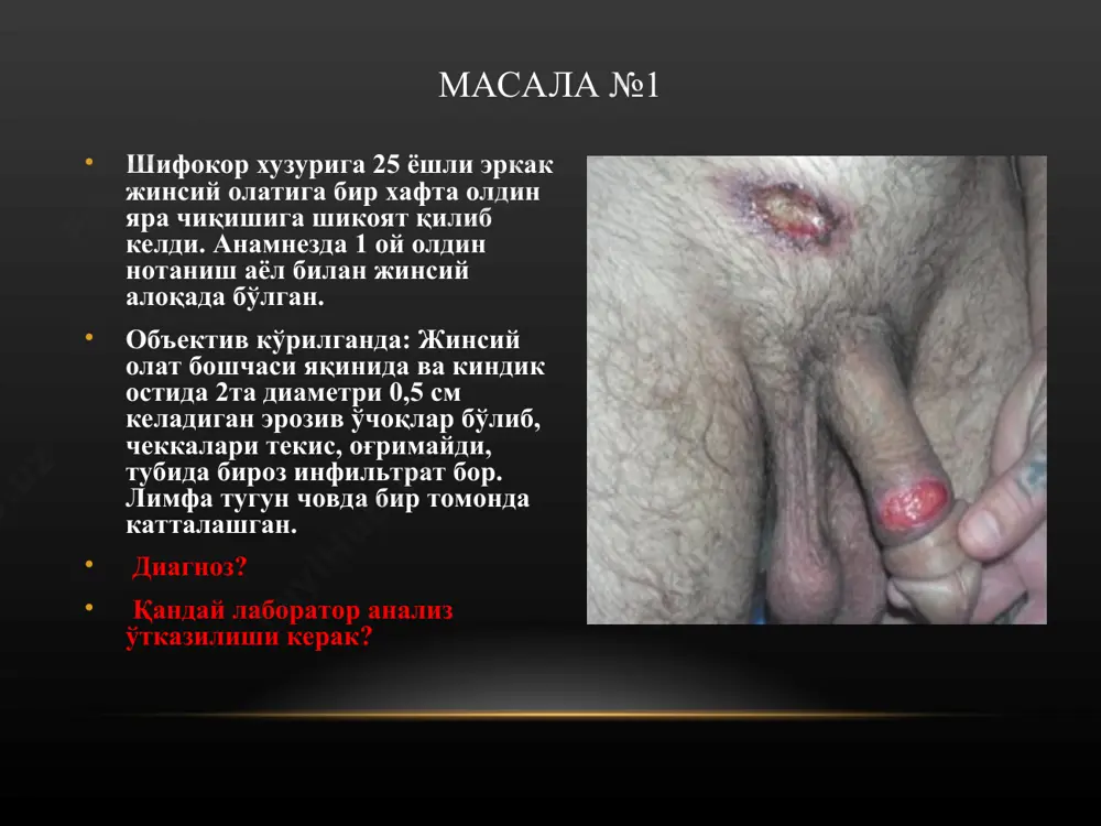 mentlar usti qaloqlar bilan qoplangan. bemorni og'riq bezovta qilmoqda. diagnozni aniqlang. tashqi muolaja buyuring. masala №4 shaxar vrachlik punktiga 19 yoshli erkak, uretradan yiring oqishiga, siyganda achishishga shikoyat qilib keldi. anamnezi: 8 kun oldin begona ayol bilan jinsiy aloqada bo'lgan. ob'ektiv ko'rilganda: uretra og'iz qismi qizargan, shishgan, yiringli qaloqlar bilan qoplangan. uretradan oqish-sarg'ish rangdagi yiring ajralyapti. palpatsiyada uretra biroz infiltratlashgan, og'riydi. limfa tugunlari kattalashmagan. sizning diagnozingiz? diagnozni tasdiqlash uchun qanday analiz o'tkazish kerak? masala№5 akusher-ginekolog ko'ruviga 24 yoshli ayol, jinsiy a'zosidagi biroz qichishishga shikoyat qilib keldi. ishlamaydi, eridan ajrashgan, betartib jinsiy hayot kechiradi. obektiv ko'rilganda: genitaliyda va orqa peshov atrofida joylashgan pushti-qizil rangdagi vegetatsiyalangan papulalar bo'lib, keng asosda joylashgan. papulalar tubida infiltratsiya bo'lib, u ushlab ko'rilganda og'rimaydi. ginekolog «keng kondiloma» diagnozini qo'ydi. sizning diagnozingiz? diagnozni tasdiqlash uchun qanday analizlar o'tkazish kerak? masala №6 bemor ayol, 30 yoshda, dermatolog huzuriga yuz sohasidagi toshmaga shikoyat qilib keldi. ob'ektiv ko'rilganda: bemoning o'ng yonoq …