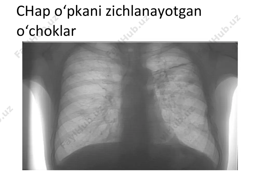 o'choqli tuberkulyoz infiltratsiya davri - Page 4