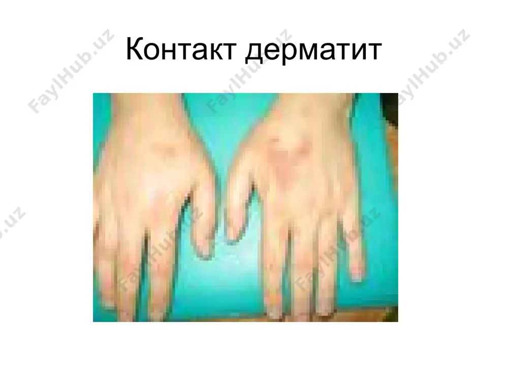 нтоксикацион терапия: гемодез, реополиглюкин, натрий хлор, декстран. 6. глюкокортикоидлар дексаметазон, гидрокортизон, переднизолон 7. анаболик гармонлар 8. калий препаратлари маҳаллий даволаш - намли боғлам қўйиш: 2% борат кислота, риванол, резорцин - анилин бўёқлари: фукорцин, метилин кўки, бриллиант яшили. - эпителизация учун гельва малҳамлар: солкосерил, актовеген, куриозин. стероидли малҳамлар ва кремлар - антибиотикли малҳамлар - оғиз шиллиқ пардалари учун: фурацилин, ромашка 1%ли борат кислота, калий перманганат, 4%ли дексаметазон эритмаси. касалхонага ётқизишга кўрсатмалар касалликнинг ўткир кечиши умумий ахволининг оғирлиги иш фаолиятининг пасайиши амбулатор даволашнинг самарасизлиги қиёсий ташхис 1. пуштиранг темратки 2. захм 3. псориаз 4. қизил ясси темратки 5. акантолитик пемфигус 6. левер пемфигоиди 7. дюринг дерматити