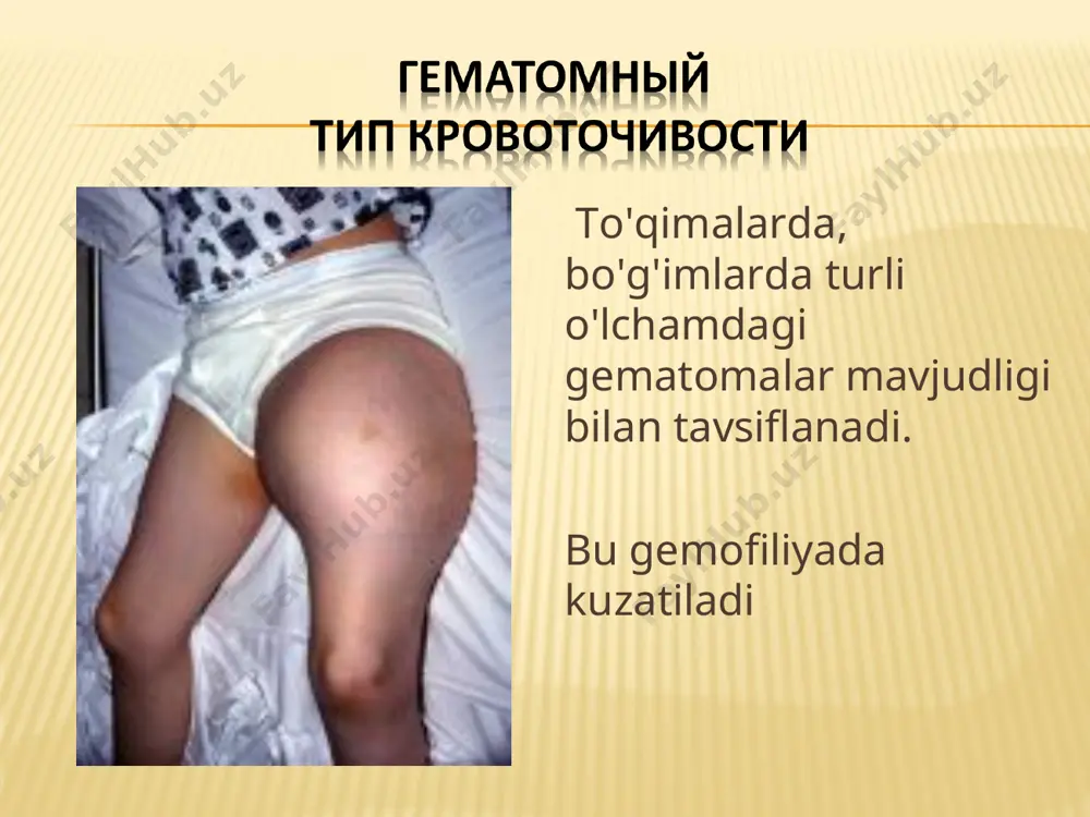 lamchi to'xtashi trombotsitlar tomonidan amalga oshirilganligi bilan izohlanadi, uning tarkibi o'zgartirilmaydi. tashxislash kapillyar va venoz qonning ivish vaqtining ko'payishi. qayta hisoblash vaqtini sekinlashtiring. tromboplastinning shakllanishini buzish. protrombin qabul qilish kamaygan. anthemofil omillardan biri (viii, ix) kontsentratsiyasining pasayishi. davolash asosiy davolanish - almashtirish terapiyasi. hozirgi vaqtda bu maqsadda viii va ix koagulyatsion omillarning kontsentratlaridan foydalanilmoqda. kontsentratlarning dozalari har bir bemorda viii yoki ix omil darajasiga, qon ketish turiga bog'liq. gemofiliya a-da, odamning yangi muzlatilgan qon plazmasidan tayyorlangan anthemofilik globulin - kриopreptabilning konsentrlangan tayyorgarligi eng ko'p qo'llaniladi. gemofiliya b bilan kasallangan bemorlarni davolashda ii (protrombin), vii (prokonvertin), ix (plazma tromboplastin komponenti) va x (styuart-praer) omillarini o'z ichiga olgan ppsb kompleks preparati qo'llaniladi. имунат коэйт дви эмоклод ди пересадка гена 1 aqsh oziq-ovqat va farmatsevtika idorasining (fda) rekombinant omillarni ishlab chiqaruvchi bayer va vaytga (2004) yozgan xatidan: "sizning dori-darmonlaringizning xavfsizligi va foydalari to'g'risida bayon etilgan materiallar noto'g'ri yoki chalg'itadi, chunki bizning ma'lumotimizga ko'ra, …
