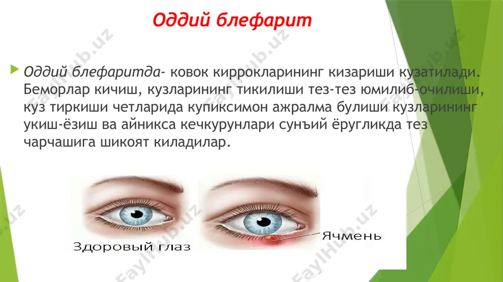 улланилади. интерферон (150-200 ед) кунига 6-8 мартагача инстилляция килиш буюрилади. шу билан бирга 0,1% дезоксирибонуклеаза эритмаси ва полудан (0,2 мг 2,0 мл дист. сувда эритилади) кунига 5-6 мартагача томизилади. теброфен, флореналь, бонафтон 0,25-0,5 % ли мазлари хам кулланилади. улар ковок ортига пунига 3-4 махал, 7-10 кун давомида куйилади. иккиламчи бактериал инфекцияни бартараф этиш учун 0,25% левомецитин эритмаси хам томизилади. image1.jpeg image2.jpeg image3.png image4.jpeg image5.png image6.jpeg image7.jpeg image8.jpeg irritated infected red bloodshot eye, barley infection in the eye /docprops/thumbnail.jpeg