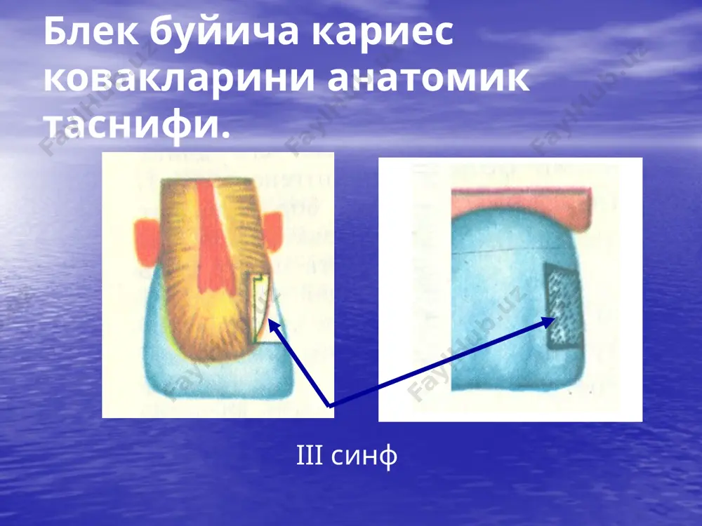 кариес ковакни чархлаш босқичлари ва услублари - Page 5