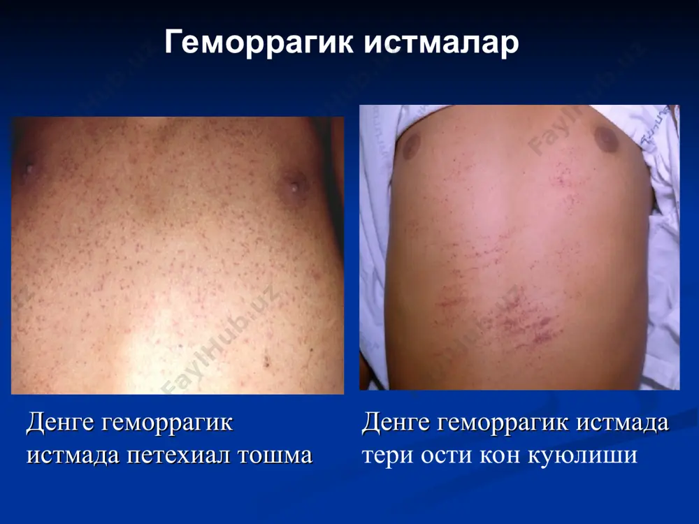 геморрагик истмалар - Page 5