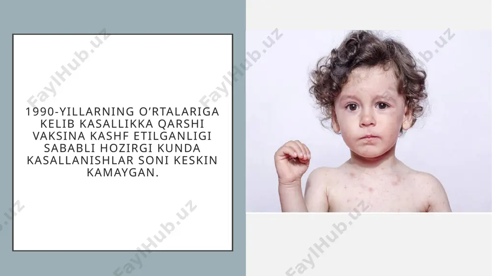 uchun og’ir asoratlar bilan yakunlanishi mumkin. tashxislash agar teri ustida notanish donachalar rivojlansa va ayniqsa, toshmalar toshishi shamollash (o’rvi) yoki grippdagi kabi belgilari bilan birga kechsa, ayniqsa homilador ayollarda, iloji boricha tezroq shifokorga murojaat qilish kerak. shifokor suvchechakni teridagi donachalar va jismoniy tekshiruv asosida tashxislashi mumkin. laboratoriya tekshiruvlariga esa tashxisni tasdiqlash uchun murojaat qilinadi. suvchechakni davolash suvchechakni davolash ham ambulator sharoitda (yengil hollarda), ham statsionarda (asoratlar mavjudligida) amalga oshiriladi. asosan ko’proq dam olish tavsiya etiladi. eng samarali davo chorasi kompleks tadbirlar bo’lib, tartib, parhez, medikamentoz davolash, shuningdek xonani shamollatish, gigiena qoidalariga amal qilish, isitmani jismoniy ravishda tushirishlarni o’z ichiga oladi. isitmali davrning butun davomida yotoq tartibiga amal qilish ko’rsatiladi. qichishishni bartaraf etish uchun antigistaminlar yoki malhamlar buyurilishi mumkin. mahalliy terapiya bakterial zararlanishni oldini olish uchun shikastlangan teri va shilliq qavatlarni dezinfektsiyalovchi eritmalar (kastellani eritmasi, gentsian binafsharangi, metilen ko’ki, kaliy permanganat eritmasi) bilan ishlov berishni o’z ichiga oladi. brilliant yashili zaruriy …