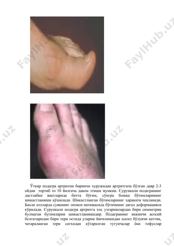 exterev kasalligi bilan 4,4%, doa bilan 26% birga uchraydi. laboratoriya tekshiruvlaridan asosiy giperurikemiya yoki uratlarni siydik bilan ajralishining kamayishini aniqlash katta axamiyatga ega. surunkali giperurikemiyaning buyrak asoratlari · siydik-tosh kasalligi · surunkali uratli (podagrik) nefropatiya · bemorlarning 20-40% proteinuriya va «yumshoq» arterial gipertenziya aniqlanadi · kam xollarda nefroskleroz, og'ir arterial gipertenziya, buyrak faoliyatining buzilishi kasallikning dastlabki vaqtlarida bo'g'imlarining rentgenografiyasida o'zgarish kuzatilmaydi. bo'g'imlarning uratlardan surunkali shikastlanishi natijasida rentgenogrammada suyak tog'ay strukturasining buzilishi belgilari ya'ni tog'ayning emirilishi natijasida bo'g'im tirqishining torayishi, suyak to'qimasining epifizda dumaloq aniq chegaralangan etishmovchiliklar (praboyniklar), suyakning subxondral qismida tofuslarning paydo bo'lishida kelib chiqadi. suyakdagi tofuslarni bo'g'im bo'shlig'iga yorilib chiqishidan, bo'g'im yuzalarida chaqalar paydo bo'ladi. bir vaqtning o'zida bo'g'im atrofidagi to'qimalarning yallig'lanishi natijasida zichlashganligi ko'riladi. ikkilamchi osteoartroz qo'shilgan yuqoridagi belgilarga xar xil darajada rivojlangan chekka osteofitozi bo'ladi. surunkali podagra artritida bo'g'imlardagi rentgenologik o'zgarishni bir necha boqichga bo'linadi. 1-bosqich. suyakning subxondral va chuqur qismida zardobli (kista), ba'zan yumshoq to'qimalarning zichlanishuvi …