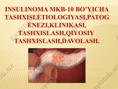 insulinoma — PPTX