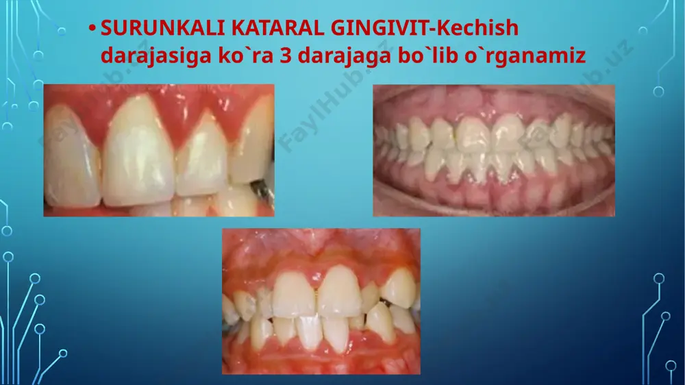 kataral gingivit - Page 3