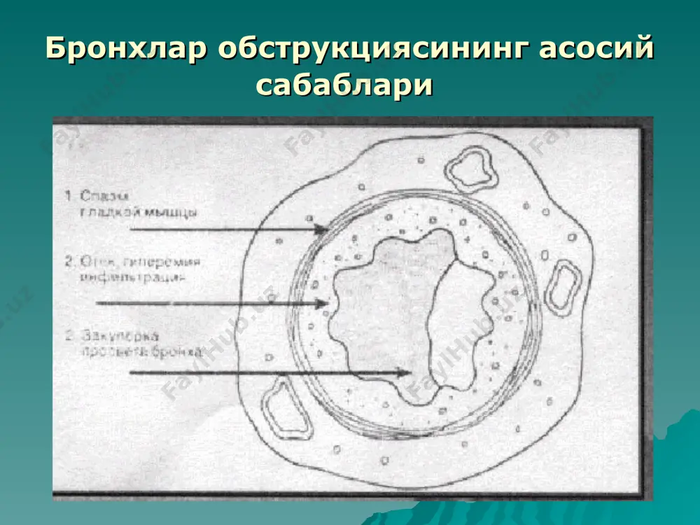 хуружлар, астматик холат тунги хуружлар й ў ±, ёки кам хафтада 2-3 марта деярли хар куни жимоний накламадо ў згармайди о ² ирлашади анча о ² ирлашади таш±и нафас нормадан 80% нормадан 60-80% 60% дан кам нафаснинг суткалик ў згариши 20% дан к ў п эмас 20-30% 30% дан к ў п ремиссия симптомлар й ў ±, таш±и нафас нормада от ў лик клиник- функционал ресиммия нафас етишмовчилик жисмоний ривожланиш ў згармаган ў згармаган ор±ада хуружни тўхтатиш ўзи тўхтайди, ёки 1 марта бронходилятатор ишлатилади бронхолитиклар, баъзан кортикостероидлар ишлатилади бронходилятаторла р ва кортикостероидлар базис терапия кромогликат натрий ( интал) кромогликат натрий, баъзан ингаляцион кортикостероидлар системли ва ингаляцион кортикостероидлар халкаро номи сотилиш номи бир мартали доза суткали доза b b 2 2 - - а а г г о о н н и и с с т т л л а а р р сальбутамол вентолин, сальбутамол 100 мг 400 мкг тербуталин …