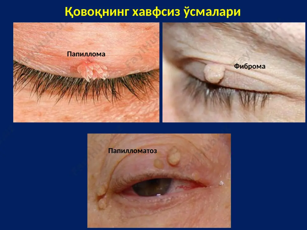 и клиникаси ўзгармас бир томонлама экзофтальм; птоз; кўз олмаси харакатини чекланиши; 50% ҳолатларда кнднинг димланиши ва кейинчалик кннинг атрофиясига олиб келади; секин прогрессияланади; дигностикаси - узи, кўз косаси кт текшируви даволаш оператив, кннинг ўсмаларида (мененгиома ва глиома) эса нур терапия; сабаби: асосий суякнинг кичик қанот соҳасида ўсма, травма ёки яллиғланиш аниқланиши (сифилитик периостит, арахноидит, менингит) шу билан бирга эшитишни пасайишини кузатилиши евстахие найи саркомасида ҳам кузатилади. ўрта мия чуқурчаси ва ғалвирсимон танага ўсиб кирадиган халқум ўсмаларида хам кузатилиши мумкин. юқори тирқиш синдроми эшитишнинг пасайиши, жағ мушакларини параличи ва кнни жараёнга қўшилиши натижасида кўрлик юзага келиши билан ҳам кузатилади. юқори тирқиш синдроми (жако–негри) анатомия n. oculomotorius иннервирует глазодвигательные мышцы, за исключением внутренней косой и наружной прямой отводящий нерв - иннервирует наружную прямую мышцу блоковый нерв - иннервирует верхнюю косую мышцу ramus ophthalmicus nervi trigemini симпатические волокна шейного узла глазничная вена (общая, верхняя) 1 — глазничная пластинка решетчатой кости; 2 — надглазничная …
