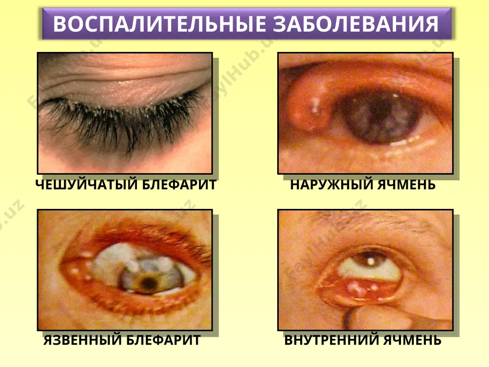 логии заболевания) 6. флюоресцеиновая проба диагностика кератитов эпителиальный кератит герпетический эпителиальный кератит древовидный герпетический кератит древовидный герпетический кератит воспалительные заболевания герпетический стромальный некротизирующий кератит воспалительные заболевания язва роговицы периферический язвенный кератит воспалительные заболевания принципы лечения кератитов 1.промывание слезных путей 2.туширование дефекта в роговице 1% бриллиантовым зеленым 3.назначение капель 6-8 раз в сутки 4.назначение мазей 4 раза в сутки 5.общая терапия(антибактериальная,противовирусная и др.) 6.десенсибилизирующая терапия 7. препараты улучшающие регенерацию роговицы спасибо за внимание