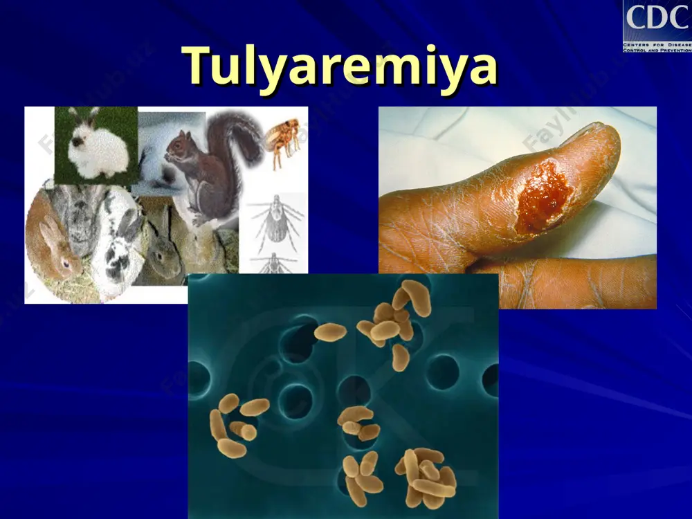 kanalar, so`nalar, chivinlar va shu kabi qon so`ruvchi hashorotlarni chaqishi orqali epidemiologoyasi kasallikni yuqish yo`llari: alimentar - kasallik qo`zg’atuvchisi tushgan suv, oziq-ovqatlar (tulyaremiya bilan og’rigan hayvonning chala pishirilgan go`shti)ni iste`mol qilish orqali epidemiologiyasi kasallikni yuqish yo`llari: kontakt - kasallangan hayvonni so`yish yoki terisini shilishda, kasallik qo`zg’atuvchisi tushgan suvdà cho`milish, kir yuvish yoki daryoni kechib o`tishda teri va shilliq qavatlar orqali epidemiologiyasi kasallikni yuqish yo`llari: aspiratsion - kasallik qo`zg’atuvchisi tushgan chang bilan nafas olish orqali (o`t o`rish, em-xashak tayyorlash, sabzavotlarni yig’ish, don-dunlarni saranjomlash jarayonida) epidemiologiyasi kasallikni yuqish yo`llari: laborator sharoitlarda yuqish tulyaremiyaning har bir yuqish yo`liga ma`lum bir klinik shakli mos keladi: yuqish yo’li klinik shakli transmissiv yara-bubon shakli havo-tomchi o’pka yaki ko’z-bubon shakli alimentar og’iz-halqum (anginoz) yoki ichak shakli kontakt bubon shakli kasallik tashuvchilari - qon so`ruvchi hashorotlar kasallik manbai - quyon, sichqon, kalamushlar... francisella tularensis yarali bubon tomoq-halqum o’pka a b c tulyaremiyaning yuqish yo`llari a = transmissiv b …
