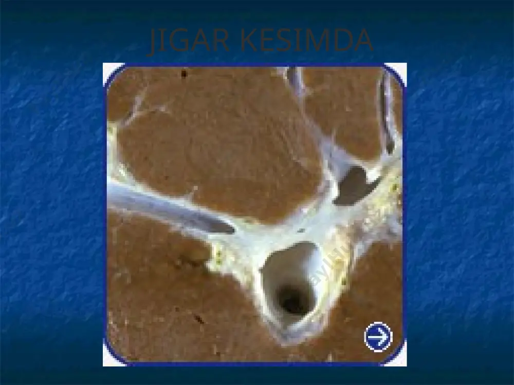 gen toksik gepatozlar patogenez jigar etishmovchiligi gepatositlarning distrofiyasi va tarqalgan nekrobiozi, hamda fibroz va portokaval anastomozlar rivojlanishi bilan tushuntiriladi. bu anastomozlar orqali qonning salmoqli qismi jigarni chetlab o'tgan holda darvoza venalaridan kavak venalarga, keyin arterial tizimga tushadi. bu holat jigarning ichakdan so'rilgan zararli moddalarni dezintoksikasiyalashdagi ishtirokini yanada kamaytiradi. klinik ko'rinishi distrofiya va atrofiya sindromi, nevrit rivojlanishi, anemiya; isitma sindromi – tana haroratinining 380 c, hatto 400c gacha ko'tarilishi, leykositar formulaning chapga siljishi, septik holat, bakteriemiya, jumladan haqiqiy ichak bakteriemiyasi sariqlik sindromi – sariqlik avj olishi bilan kechuvchi massiv nekroz klinik ko'rinishi (davomi) endokrin buzilishlar sindromi – urg'donlar atrofiyasi, bepushtlik, ginekomastiya, soch to'kilishi, sut bezlari va bachadon atrofiyasi, teleangiektaziyalar paydo bo'lishi va tezlik bilan kattalashishi, palmar eritema, «oq tirnoqlar fenomeni» gemodinamika buzilishi sindromi– diffuz vazodilatasiya, shish-assitik sindrom mahsus jigar hidi aniqlanishi gemorragik diatez jigar etishmovchiligi bosqichlari prekomatoz – bemor shahsiyatining o'zgarishi, qo'zg'alish, agressivlik. jigar kichiklashishi avj oladi, albumin, aminotransferazalar faolligi, gamma-globulinlar …