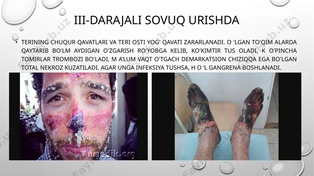 etmagan bo'lsa, qaynoq ichimliklar (choy, kofe) beriladi. sun’iy nafas oldiriladi va bilvosita yurak massaj qilinadi. 4 soatlik interval bilan gidrokarbonat natriy arteriya yoki vena tomiriga yuboriladi. agar sovuq olish o'z vaqtida to'xtatilgan bo'lsa, organizm a ’zolari funksiyasi tezda o'z holiga keladi image2.png image3.png image4.png image5.png image6.png image7.png image8.png image9.png image10.png image11.png image12.png image13.png image14.png image15.png image16.png image17.png image18.png image1.png