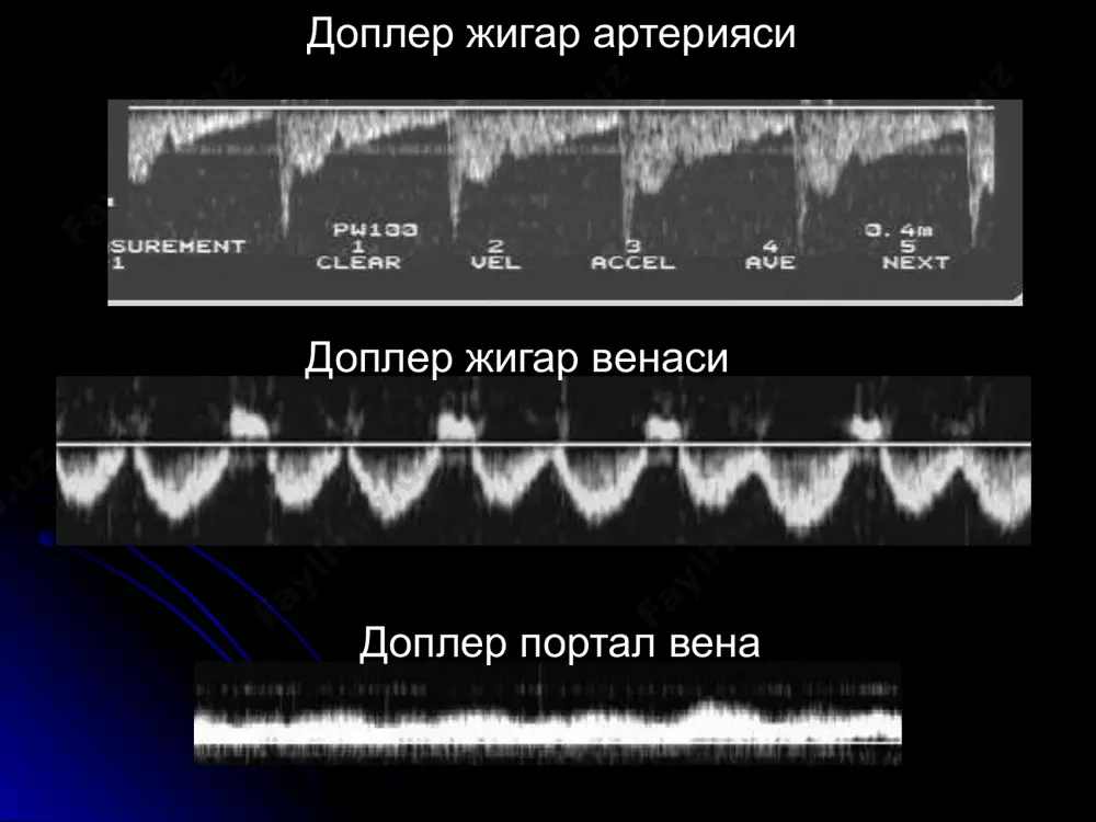 1.5 см гача (90%), ногомоген булиши мумкин (кон, кальцинат, некроз), атрофида шиш зонаси ус - гипер-изо-гипоэхоген кт - гиподенсив кт+контраст - эрта ва яхши йигади mts холецистит уткир тошли (80-90%), кекса аеллар (х3) сг - девори > 3мм, 3 каватли, улчами катта, ут ногомоген, тош - гиперэхоген, акустик соя ва силжиш тошлар 85% охаклашмаган, турлари - холестерин (70%), билирубин (30%), тошсиз (10%) купинча операциядан сунг, белгилари юкоридек, лекин тош йук. сурункали - чандикли деформация +функцияси бузилиши тош ут йулида булса холангиография ахамиятли полиплар акустик соя бермайдилар полип тош уткир тошсиз холецистит уткир холециститни сонография курсатмаса, радионуклид текширув аниклаши мумкин (ут копи куринмайди 4 соат ичида) image1.jpeg image2.png image3.png image4.png image5.png image6.png image7.png image8.jpeg image9.jpeg image10.jpeg image11.jpeg image12.png image13.jpeg image14.png image15.jpeg image16.jpeg image17.jpeg image18.jpeg image19.jpeg image20.jpeg image21.jpeg image22.jpeg image23.png image24.jpeg image25.jpeg image26.png image27.jpeg image28.jpeg image29.jpeg image30.png image31.jpeg image32.jpeg image33.jpeg image34.png image35.jpeg image36.jpeg image37.jpeg image38.png image39.jpeg image40.gif image41.jpeg image42.jpeg image43.jpeg image44.jpeg image45.jpeg …