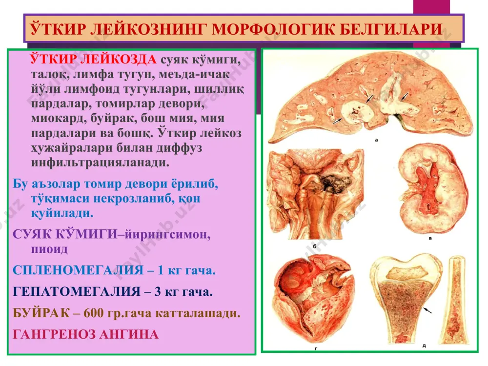 сида эритроцитлар мембранаси ригидланади. эритроцитлар талокда секвестрланиб 20кунда нобуд булади ригидланган уроксимон эритроцитлар капиллярларга тикилади эритроцитлар заряди узгариб эндотелийга ёпишади коннинг ивиши тезлашади. гемоглобинопатия уроксимон хужайрали анемияда патанатомия: макро: юрак, жигар, буйрак ёгли дистрофия окибатида оч сарик рангли. талок- спленомегалия (500г) инфаркт учоклари. расм микро: юрак, буйрак эгри-бугри каналчаларида, жигар паренхиматоз ёгли дистрофия. конда уроксимон эритроцитлар ва ретикулоцитоз. суяк кумиги гиперплазияси, экстрамедуляр гематопоэз. умумий гемосидероз, гемохроматоз. расм 3. талассемия бу- гемоглобиннинг a-глобин ва в-глобин занжирлари синтези бузилишидан ривожланадиган ирсий анемиядир. сабаби ва механизми: гемоглобин генлари мутацияси, делецияси ва транскрипцияси, бекарон рнк синтезланиши. патнатомияси: макро: спленомегалия, гепатомегалия, кумик гиперплазияси, суякнинг юпкаланиши, гемосидероз, сариклик. микро: конда- аницитоз, пойкилоцитоз, ретикулоцитоз. эктрамедуляр гематопоэз. расм iii. дисэритропоэтик эритропоэз бузилиши окибатида бошланадиган анемиялар суяк кумигининг гемопоэз учун зарур моддалар билан тегишлияа таъминланмагинлигидан келиб чикувчи анемиядир. турлари: 1.fe танкислигига боглик анемия 2.мегалобластик анемия 3. гипопластик ва апластик анемия 4.миелофтиз анемия 1. темир танкислигига боглик анемия сабаби: а) …