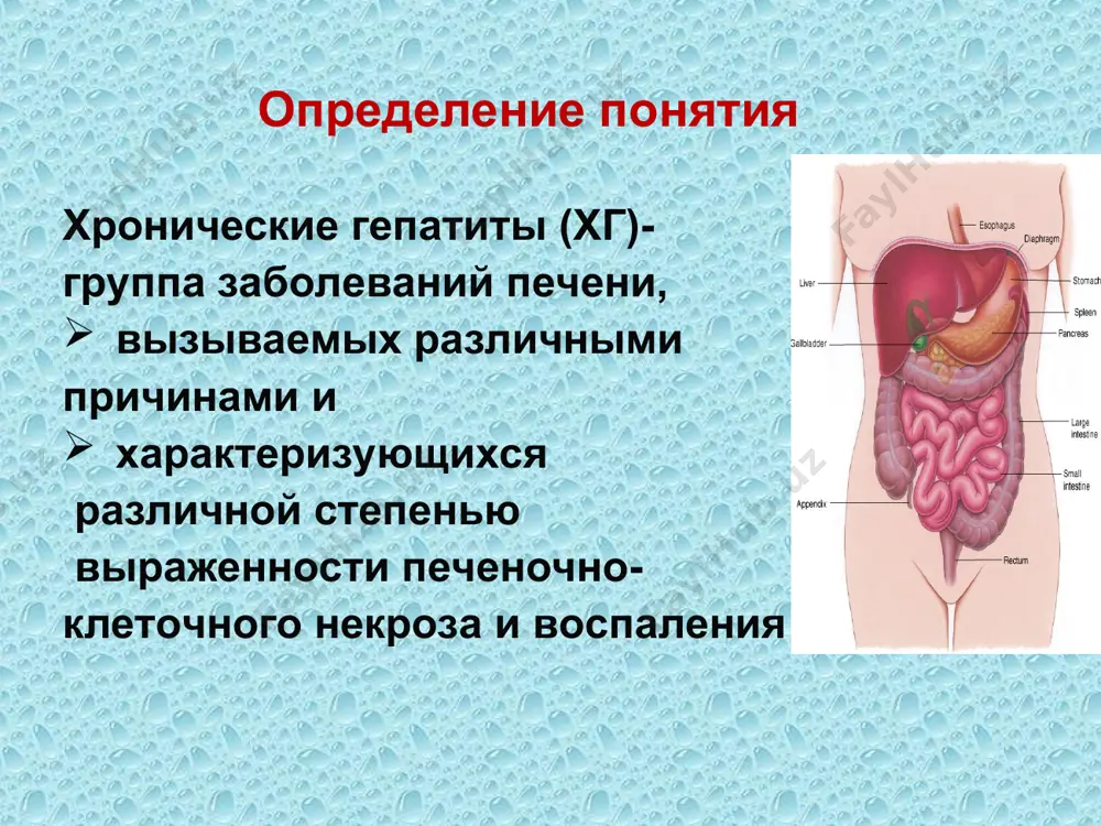 ывают повреждающее действие 2) опосредованное действие, изменяя метаболические процессы в печени 3) нарушая экскрецию желчи. лекарственные вещества могут вызвать хг за счет 1. реакции гиперчувствительности токсического действия их метаболитов, образующихся в процессе биотрансформации в печени (метаболическая идиосинкразия) существенное значение в развитии хг имеет: - сочетанное применение лекарств - длительность их введения - предшествующие поражения печени. патоморфология и гистология i. у больных хроническими вирусными гепатитами лимфогистиоцитарная инфильтрация в портальных трактах «ступенчатые» некрозы, прилегающие к портальному тракту, и «мостовидные» некрозы (занимающие пространство от портального тракта до центральной вены, или от одного портального тракта до другого). ii. при алкогольном поражении печени - макровезикулярный стеатоз (крупнокапельное ожирение печени). iii. при алкогольном гепатите характерна инфильтрация в центролобулярной зоне полиморфно-ядерными лейкоцитами и портальное мононуклеарное воспаление. схема морфологии печени гистологические критерии активности процесса в печени (knodell и соавт). 1) перипортальные, включая мостовидные, некрозы гепатоцитов (0-10 баллов). 2) внутридольковые фокальные некрозы и дистрофия гепатоцитов (0-4 балла) 3) воспалительную …