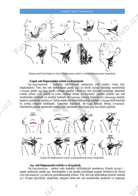 tasmali yoki nay drenaj o‘rnatiladi va operatsion jarohat operatsion jarohat gipertonik eritma yoki antiseptik shimilgan bog‘lam bilan yopiladi. 3 toshkent tibbiyot akademiyasi halqum atrofi kletchatka bo‘shlig‘i flegmonasini ochish va drenajlashning asosiy bosqichlari. engak osti flegmonasini ochish va drenajlash. og‘riqsizlantirish – mahalliy infiltratsiyali anesteziya yoki narkoz (vena ichi, ingalyatsion). teri, teri osti kletchatkasi pastki jag‘ va tilosti suyagi orasidagi masofaning o‘rtasida pastki jag‘ning pastki chetiga parallel chiziq bo‘ylab kesiladi (sohadagi abssessni ochish uchun o‘rta chiziq bo‘yicha vertikal kesim qo‘llaniladi). jarohat chetlari teri osti muskulidan ajratiladi va muskul kesiladi. bo‘yinning xususiy fassiyasi bo‘ylamasiga kesilib, qisqich yordamida tumtoq yo‘l bilan engak osti kletchatkasidagi yiringli o‘choqqa kirib boriladi va yiring chiqarib tashlanadi. gemostaz bajariladi. bo‘liqqa tasmali drenaj o‘rnatiladi. operatsion jarohat gipertonik eritma yoki antiseptik shimilgan bog‘lam bilan yopiladi. engak osti flegmonasini ochish va drenajlashning asosiy bosqichlari. jag‘ osti flegmonasini ochish va drenajlash. og‘riqsizlantirish – narkoz yoki mahalliy infiltratsiyali anesteziya. kesish chizig‘i – engak markazini …