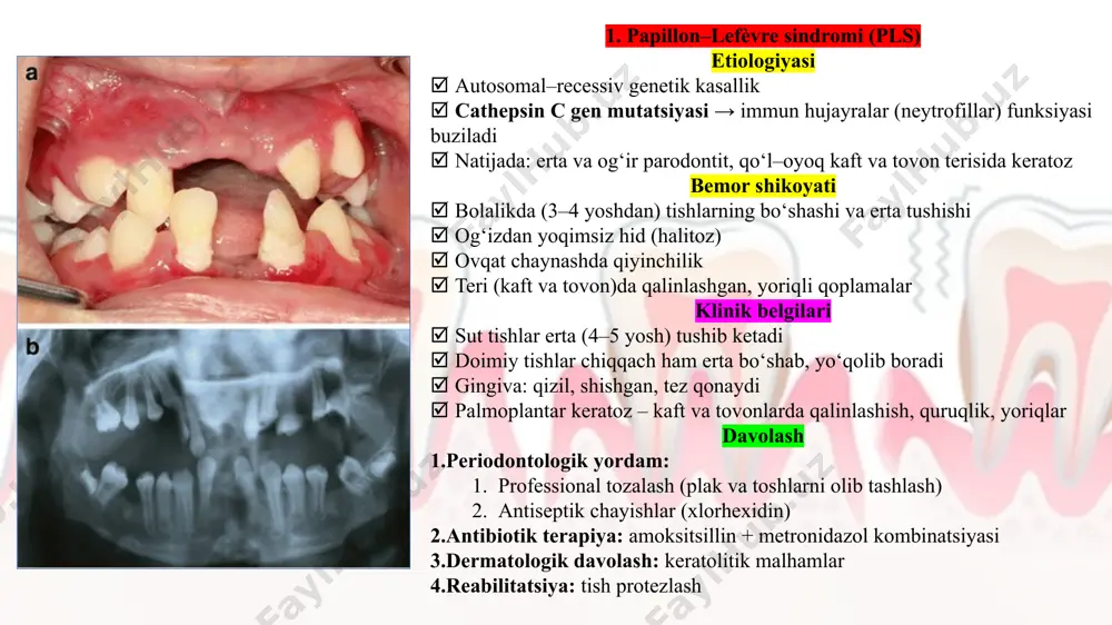 chaynash apparatini mashq qildirish. 3. ko’rsatma asosida – erta ortodontik va ortipedik davolash. 4. og'iz bo’shlig'ini tozalash bo’yicha rag'batlantirish ishlarini olib borish. 5. lab, til va kichik daxliz yugancha larining birikishi anomaliyalariga bog'liqxavfomillarini aniqlash va bartaraf etish. 6. suprakontaktlarni bartaraf etish uchun tishlarni tanlab silliqlash. 7. bruksizmni aniqlash va davolash. 8. og'iz bo’shlig'i sanatsiyasi. ikkilamchi profilaktika parodont kasalliklarini erta aniqlash, kasallikningrivojlanishini va asoratlar kelib chiqishining oldini olishga qaratilgan. ikkilamchi profilaktika uchun amalga oshiriluvchi chora-tadbirlar: 1. travmalovchi omillarni bartaraf etish (tish toshlari, osilib turuvchi plombalar,sifatsiz ortopedik va ortodontik moslamalar, prikus anomaliyalari, karioz bo’shliqlar). 2. professional gigiyena, nazorat ostida tishlarni tozalash. 3. gingivitni davolash. uchlamchi profilaktika parodont kasalliklarini og'ir turiga o’tishini, kasallikningqaytalanishini oldini olishga, chaynov apparatining vazifasini qaytatishlashgayo’naltirilgan. uchlamchi profilaktika terapevtik, jarroxlik, ortopedikvafizioterapevtik muolajalarni o’z ichida mujassamlashtiradi. parodontologiyada dispanserizatsiya parodont kasalliklarini erta aniqlash, davolash va muntazam nazorat qilishga qaratilgan profilaktik kuzatuv tizimi. maqsadlari: kasallikni erta aniqlash surunkali jarayonlarni og‘irlashishidan saqlash og‘iz gigiyenasini …