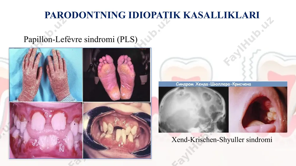 hlarning tez bo‘shashishi va yo‘qolishi og‘izdan yomon hid gingival og‘riq, shish umumiy: suyak og‘riqlari, limfa tugunlarining kattalashishi, isitma klinik belgilari tishlar “havoda turgandek” (alveolar suyagi erib ketgan) gingiva qizil, qonaydi periodontal cho‘ntaklar chuqur rentgen: alveolar suyakda lytic o‘choqlar ba’zida terida qizil toshmalar, limfadenopatiya davolash mahalliy parodont davosi: professional tozalash, antiseptiklar umumiy davolash: kortikosteroidlar (prednizolon) kimyoterapiya (vinblastin, etoposid, metotreksat) og‘ir shakllarda simptomatik yordam: og‘riqni kamaytirish, ikkilamchi infeksiyani nazorat qilish reabilitatsiya: yo‘qotilgan tishlarni protezlash yoki implantatsiya x-gistiotsitoz (langerhans hujayrali histiotsitoz, gistiotsitoz–x) kasallik etiologiyasi bemor shikoyati klinik belgilari davolash papillon–lefèvre sindromi (pls) autosomal–recessiv, cathepsin c gen mutatsiyasi → neytrofil disfunksiya tishlarning erta bo‘shashi, og‘izdan yoqimsiz hid, chaynash qiyinligi, qo‘l–oyoq terisida yoriqlar sut va doimiy tishlarning juda erta yo‘qolishi, gingiva qizarishi va qonashi, palmoplantar keratoz antiseptik chayish, antibiotik (amoksitsillin + metronidazol), keratolitik malhamlar, protezlash hand–schüller–christian sindromi (histiotsitoz turi) langerhans hujayralar proliferatsiyasi, immun buzilish tishlarning bo‘shashi, og‘izda yomon hid, bosh og‘rig‘i, ko‘p siyish, chanqash triada: …