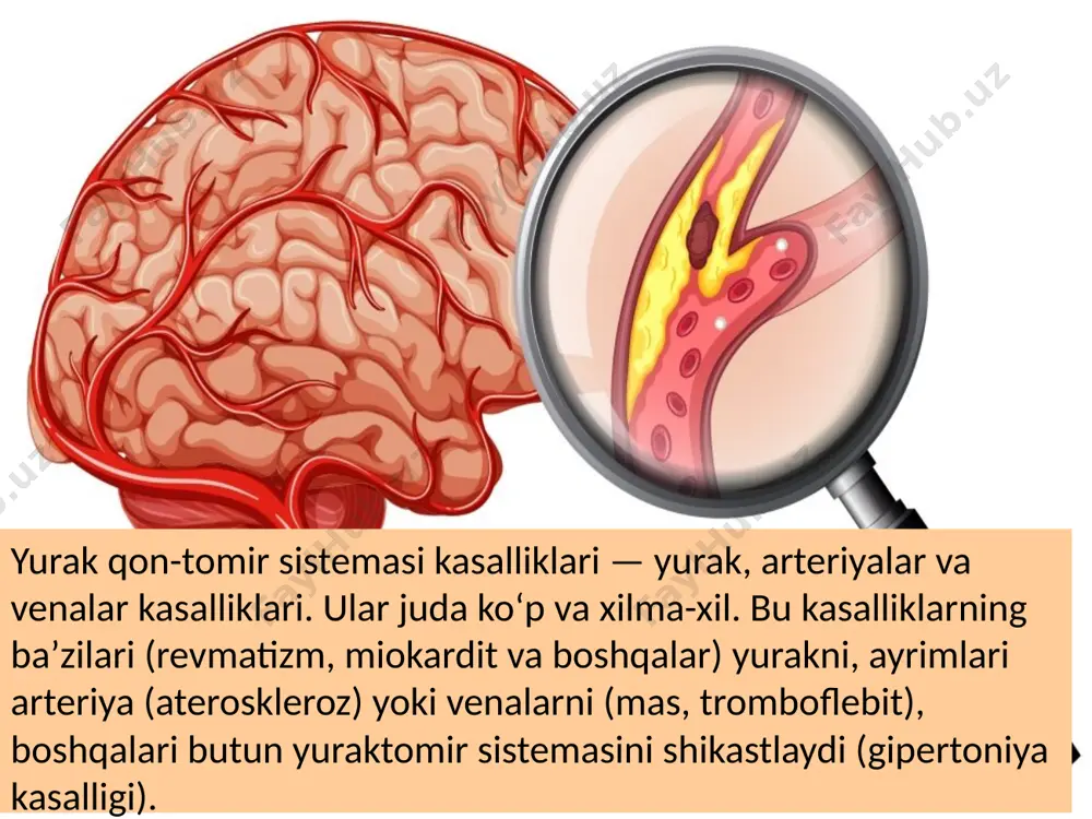 ‘krak qafasida bosim va noqulaylikni sezish mumkin. og‘riq orqa tomon, bo‘yin, yelka, qo‘l va tirsaklarga o‘tishi ham ko‘p kuzatiladi. yana shuningdek nafas qisishi, aritmiya (yurak urishi tezlashishi), uyqusizlik va kuchli charchoq hissi ham paydo bo‘ladi. asosiy alomatlari — to‘satdan qotib qolish yoki qo‘l- oyoqlarda holsizlik, nutq chalkashishi, ya'ni, tushunarsiz gap-so‘z, vaqtincha ko‘rish qobiliyati sustlashishi, bosh aylanishi, yurganda noaniq qadam tashlash, kuchli bosh og‘rig‘i, hushdan ketish. qo‘l-oyoq tomirlaridaorganizmning bu qismlaridagi arteriyalar qisqarsa, asosan harakat davomida og‘riq va uvishish kuzatiladi buyrak arteriyalaridagi yog‘ toshmalari buyrak yetishmovchiligi rivojlanishiga olib kelishi mumkin. uning asosiy belgilari: kuchsizlik, ishtaha yo‘qolishi, ko‘ngil aynishi, juda tez yoki kam siyish, qo‘l-oyoqlarda shish, fikrni jamlash bilan muammolar, teri qichishishi xastalik bolalikdayoq paydo bo‘lishi mumkin. sababi aynan aniqlanmagan. odatda bu endoteliyga - arteriyaning ichki qatlamiga zarar yetkazish natijasida yuzaga keladi. tomirlarga quyidagilar zarar yetkazishi mumkin: yuqori qon bosimi; tamaki chekish; xolesterin yoki triglitseridlar darajasi oshishi; diabetning birinchi toifasi; vazn ortishi, semirish; …