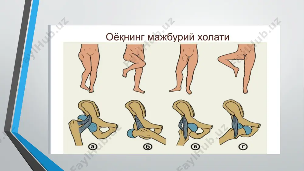iyotning yo‘qolishi yoki oyoqni harakatlantira olmaslik kabi nevrologik alomatlarni keltirib chiqarishi mumkin. - qon tomirlarining zararlanishi: bo‘g‘imdagi dislokatsiya atrofdagi qon tomirlarini siqib qo‘yishi yoki ularga shikast yetkazishi mumkin. agar bu holat vaqtida aniqlanmasa, qon aylanishi buzilishi natijasida oyoqning to‘qimalarida o‘lish va nekroz yuzaga kelishi mumkin. bu asorat tezkor jarrohlik aralashuvini talab qiladi. 4. reaktiv artrit - dislokatsiyadan keyin bo‘g‘imda yallig‘lanish jarayoni rivojlanishi mumkin. bu holat reaktiv artrit deb ataladi va bo‘g‘imning shishi, og‘rishi, qizishi va harakatlanish qobiliyatining buzilishi bilan kechadi. asoratlari 5. infeksiya - agar dislokatsiya ochiq jarohat bilan bog‘liq bo‘lsa yoki dislokatsiyani davolash jarrohlik yo‘li bilan amalga oshirilgan bo‘lsa, infeksiya rivojlanishi xavfi bo‘lishi mumkin. bu holat, ayniqsa, jarrohlik paytida to‘qimalar zarar ko‘rsa, jiddiy hisoblanadi. - infeksiyalar bo‘g‘imda yiringlash va shikastlanishlarga olib kelishi, bo‘g‘imni davolashni murakkablashtirishi mumkin. 6. suyak sinishi bilan bog'liq asoratlar - ba'zi hollarda dislokatsiya suyak sinishi bilan birga kechishi mumkin. bu jarohat bo‘g‘imning tiklanishiga salbiy ta’sir ko‘rsatadi, …