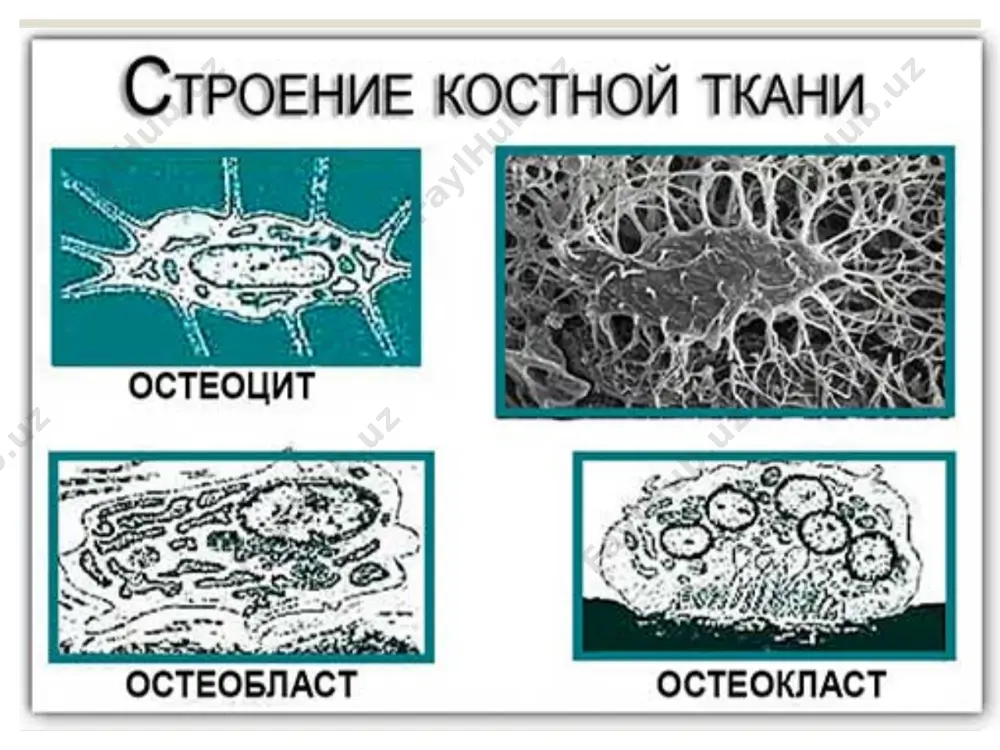 ей характерен длительный (4-5 лет) анамнез с малой выраженностью симптомов и достижением больших размеров. при анаплазированных хондросаркомах (чаще у молодых) длительность симптомов не превышает 1-3 мес. основные симптомы – боли, припухлость. боли отмечаются постоянством, прогрессивным нарастанием интенсивности. увеличение размеров опухоли идёт месяцами, иногда годами, особенно при вторичных хондросаркомах. другие местные симптомы, такие как расширение подкожных вен, местное повышение температуры, нарушение функции сустава, менее выражены, чем при остеосаркоме или совсем отсутствуют. злокачественные опухоли костей (зок) хондросаркома рентгенологически характеризуется наличием центрально или эксцентрически расположенного очага деструкции остеолитического характера, чаще больших размеров, с нечеткими контурами и отсутствием зоны склероза. характерны участки обызвествления в проекции очага деструкции кости. при эксцентрическом расположении опухоли или при увеличении размеров центрально расположенной хондросаркомы, наблюдается истончение, вздутие и разрушение кортикального слоя с проявлением экстраоссального компонента с участками обызвествления. козырек кодмена нехарактерен. возможны слоистые и бахромчатые периостальные наслоения. различают центральную хондросаркому (из внутренних отделов кости) и периферическую (из поверхностных слоев …