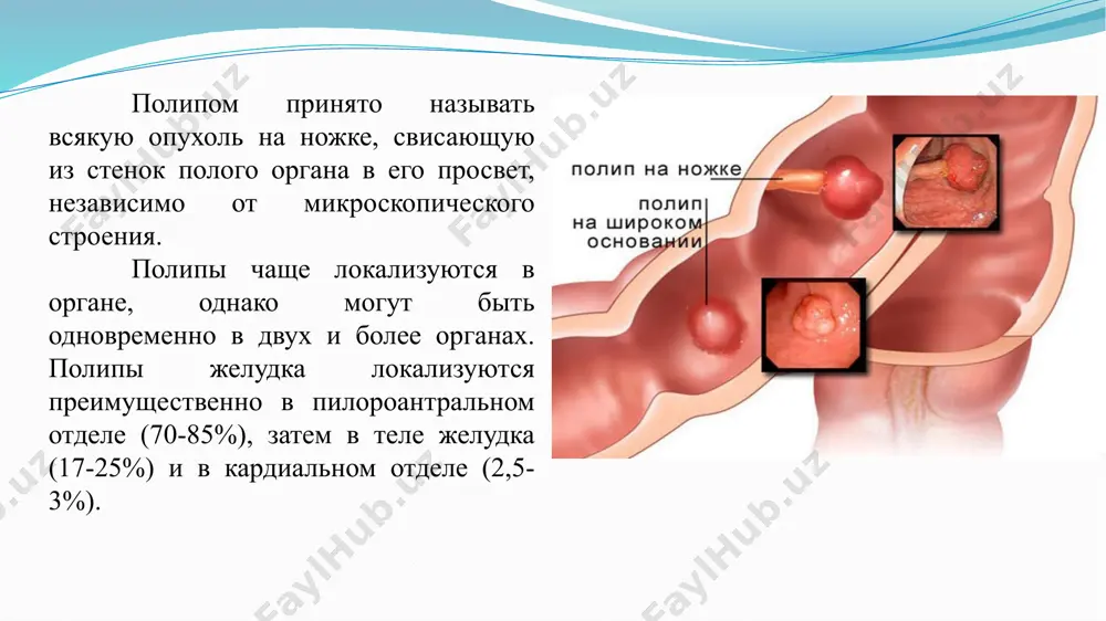 zabolevaniya chashe vsego nezametnoe, postepennoe. boli v podlojechnoy oblasti – samiy chastiy simptom pri polipax jeludka. boli noyushego i tupogo xaraktera lokalizuyutsya preimushestvenno v epigastralnoy oblasti. inogda boli v jivote imeyut raznoobrazniy xarakter bez opredelennoy lokalizatsii, irradiiruyut vv oblast lopatki, poyasnitsi i v osnovnom svyazani s priemom pishi. chashe boli voznikayut cherez 1,5-3 ch posle priema pishi i prodoljayutsya inogda 2-3 ch, zatem stixayut. chuvstvo tyajesti v podlojechnoy oblasti; bistraya nasishaemost pri prieme pishi; otrijka; izjoga; toshnota, reje rvota; nepriyatniy vkus vo rtu; slyunotechenie; neustoychiviy stul; meteorizm; diagnostika oak (gipoxromnaya anemiya v 25% sluchaev); issledovanie jeludochnogo soka; analiz kala na skrituyu krov; - efgds; - biopsiya polipa: metaplaziya jelezistix kletok razlichnoy intensivnosti; rentgenodiagnostika: «defekt napolneniya» obichno raspolojen na peredney ili zadney stenke, blije k maloy ili bolshoy krivizne jeludka i otdelen ot nix poloskoy neizmenennoy slizistoy obolochki, vipadenie peristaltiki na urovne polipa, chto ukazivaet na infiltratsiyu podslizistogo, a inogda i …