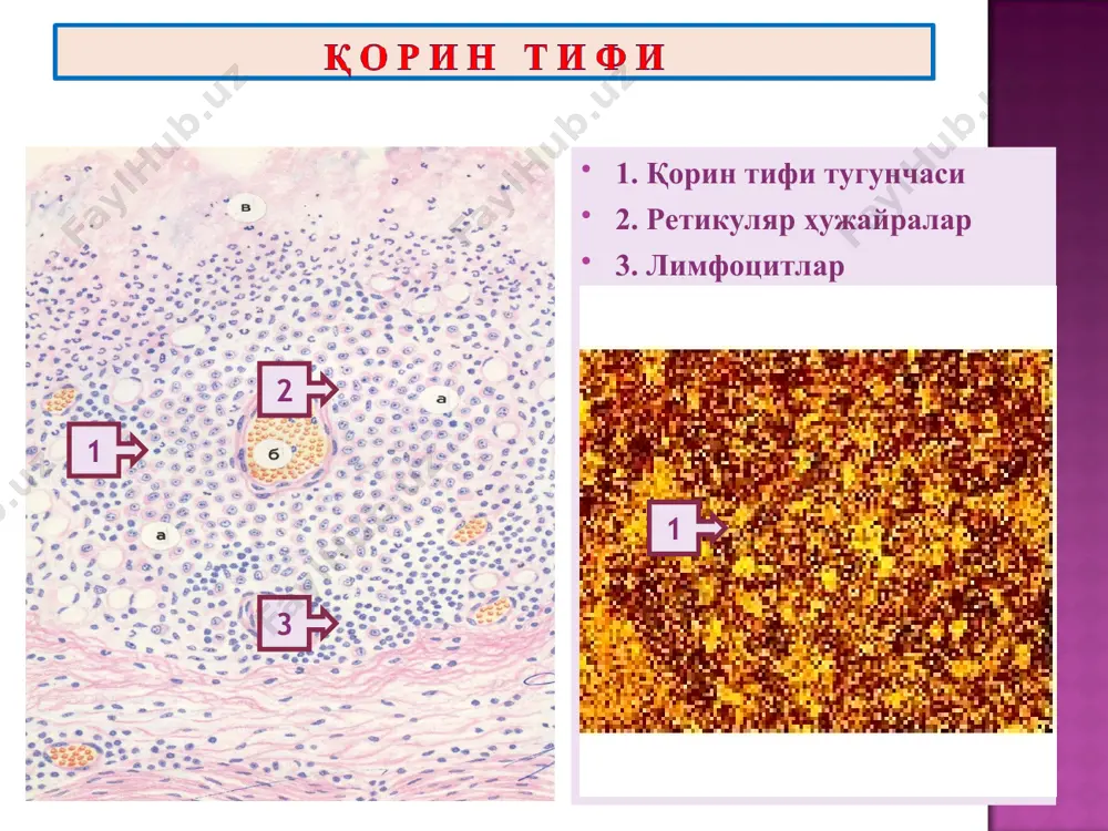 у даврда мурданинг тез қотиши, эксикоз, мушакларнинг контрактураланиб қотиши («гладиатор қиёфаси»), қўл терисининг қуриб, бужмайиб қолиши («кир ювувчининг қўли»), ўт пуфагининг кенгайиб оқиш сафро билан тўлиши кузатилади. 1. катарал энтерит 2. десквоматив энтерит асоратлари ва ўлим сабаблари. специфик асоратлари: вабо тифоиди – бу вибрионнинг қайта тушишига нисбатан гиперергик реакция бўлиб, ичакда фибринозли дифтеритик яллиғланиш ривожланиши билан давом этади. вабо уремияси – бу алгид давридан кейин ривожланиб, буйраклар пўстлоғида инфарктга ўхшаш некрозлар пайдо бўлади. носпецифик асоратлари: пневмония, абсцесслар, флегмона, рожа, сепсис. ўлим – алгид даврида сувсизланишдан, комадан, уремиядан ва интоксикациядан ривожланади.