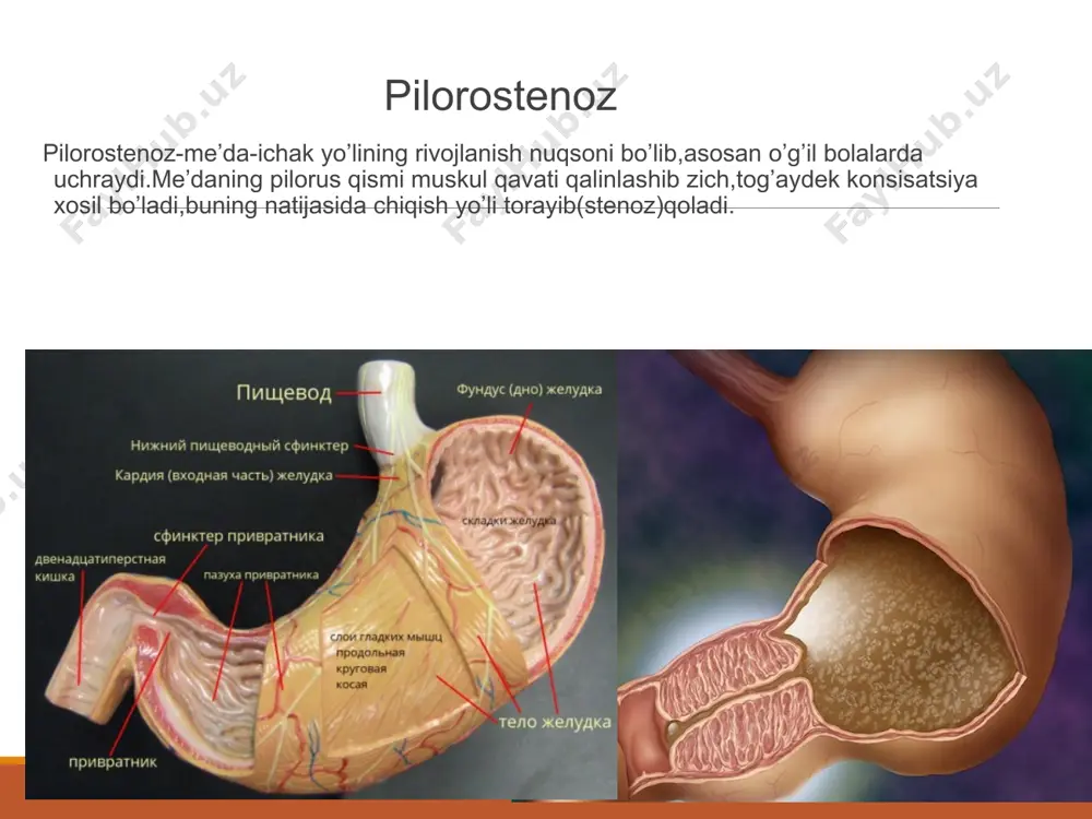 k jihatdan yara kasal-ligining odatdagi simptomlari fonida me'daning tolib ketish sezgisi, epigastriyda, ayniqsa kop ovqat yeyilgandan keyin ogirlik paydo boladi. nordon kekirish, ba'zan me'da suyuqligi aralash nordon hidli qayt qilish yengillik beradi. rentgenologik tekshiruvda me'da olchami normal, biroq gipermotorika, bariyning ortacha tutilib qolishi aniqlanadi. dekompensatsiyalangan stenoz me'dada suyuqlik evakuatsiyasining keskin buzilishi, umumiy holatning yomonlashishi bilan otadi. me'dada suyuqlikning turib qolishi me'daning chozilib ketishiga, dilatatsiyasiga olib keladi, me'dada bir necha litrgacha badboy suyuqlik toplanib qoladi, palagsa bolgan tuxum hidi keladigan kekirish paydo boladi. atayin qozgatilgan qusishdan keyin bemor ahvoli vaqtinchalik yengillashadi, biroq tez-tez qayt qilish, kop mikdorda suyuqlik, xloridlar, kaliy ionlari yoqotish degidratatsiyaga, qonning quyuklashuviga, xloridlar kamayishiga, alkaloz, diurez kamayib ketishiga olib keladi. bemorlarning umumiy ahvoli yomonlashadi, ular ozib ketadi, teri qoplamining elastikligi pasayadi, adinamiya boladi. qorin devorining turtkisimon chayqalishlarida «chayqalish shovqini», me'dada kozga korinadigan qisqarish aniqlanadi. klinikasi belgilari asta sekin avj olib boradi.sutni qaytarib tashlash xodisasi 2-3haftalik bo’lganda paydo bo’ladi, …