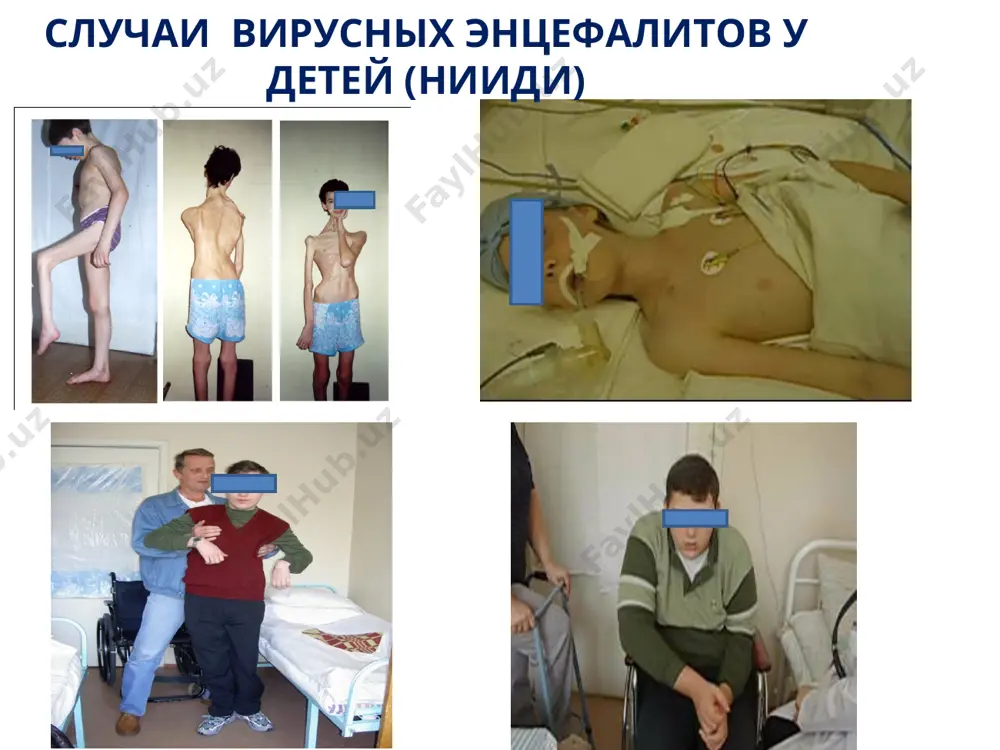 us австралия murray valley encephalitis virus, japanese encephalitis virus, нendra virus россия tick born encephalitis европа west nile virus, tick born encephalitis средиземноморье west nile virus центральная и южная америка rabies virus, easten equine encephalis virus, westen equine encephalis virus, venesuelan equine encephalitis virus, st. louis virus азия, китай, тихоокеанский регион japanese encephalitis virus, tick born encephalitis, nipah virus индия, непал rabies virus, polio virus, japanese encephalitis virus факторы риска развития энцефалитов (продолжение) сезонность весенне-летняя/летне-осенняя сезонность enterovirus, tick born encephalitis, powassan virus easten equine encephalitis virus, westen equine encephalitis virus, venesuelan equine encephalitis virus, зимняя influenza virus, adenovirus, hsv отсутствие вакцинации vvz, tick born encephalitis, japanese encephalitis virus, west nile virus, poliovirus, measles virus, mumps virus, rubella virus фактор риска предполагаемый инфекционный агент контакты с насекомыми - москитами - клещами -easten equine encephalis virus, westen equine encephalis virus, venesuelan equine encephalitis virus -tick born encephalitis, powassan virus основные хозяева и …