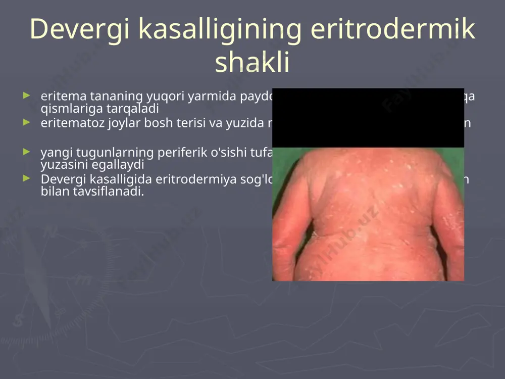 devergi kasalligining eritrodermik shakli - Page 3