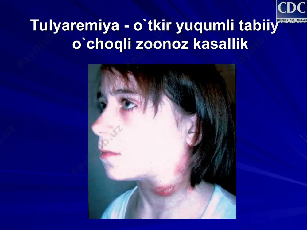t vozdeystviya infitsirovannoy aerozoli (c). xotya legochnaya forma tulyaremii mojet bit takje i vtorichnoy v rezultate gematogennogo rasprostraneniya infektsii posle kakoy-libo iz pervichnix form. anginozno-bubonnaya (rotoglotochnaya) forma tulyaremii razvivaetsya v rezultate popadaniya zaraznogo materiala v rot, a abdominalnaya (kishechnaya) – pri zaglativanii ego (d) kasallikning klinik shakllari bubon / yara-bubon shakli ko`z-bubon shakli anginoz-bubon shakli o`pka shakli ichak shakli tulyaremiyaning klinik manzarasi kasallik qanday klinik shaklda namoyon bo`lishidan qat`iy nazar, boshlang’ich davri bir xilda kechadi: o`tkir boshlanadi tana haroratini 38-400c gacha ko`tarilishi qaltirash bosh og’rishi holsizlik mushaklarni qaqshab og’rishi ishtahasizlik eyforik holat yuzning shishishi va qizarishi ko`z shilliq qavati (kon`yunktiva) ning qizarishi boshlang’ich davr 2-3 kun davom etib, so`ng kasallik avj olish davriga o`tadi: isitma zaharlanish alomatlari ayrim hollarda jigar va taloqning kattalashishi har bir klinik shaklga xos belgilarning yuzaga chiqishi tulyaremiyaning barcha shakllariga xos bo`lgan belgi - limfadenit yoki bubondir! kasallikni yuqishi inkubatsion davr 3 - 5kun asoratlari: ikkilamchi …